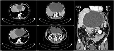 Case Report: Liver Cysts and SARS-CoV-2: No Evidence of Virus in Cystic Fluid